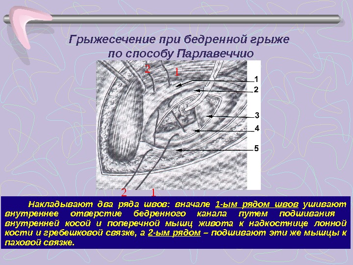 Грыжа передней брюшной стенки карта вызова