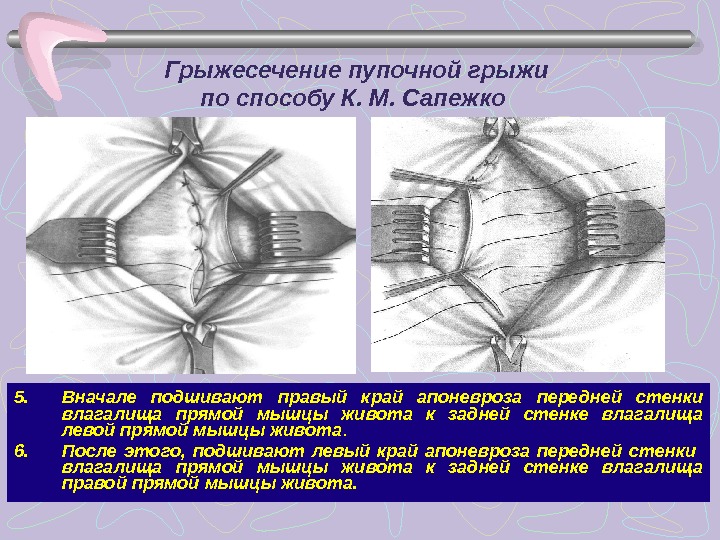 Грыжа передней брюшной стенки карта вызова