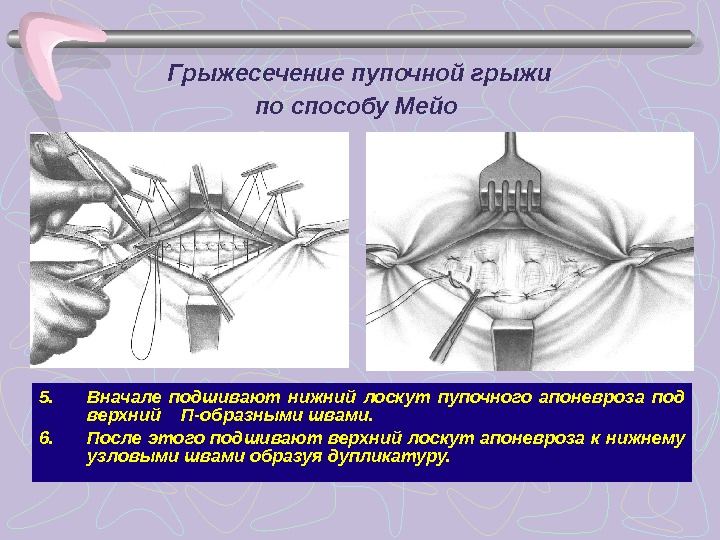 Операция белей. Операция Мейо при пупочной грыже. Операция грыжи по методу Мейо. Метод Мейо при пупочной грыже. Герниопластика пупочной грыжи по Мейо.