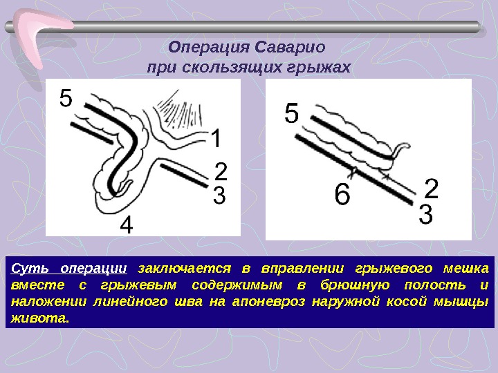 Грыжа брюшной стенки карта вызова