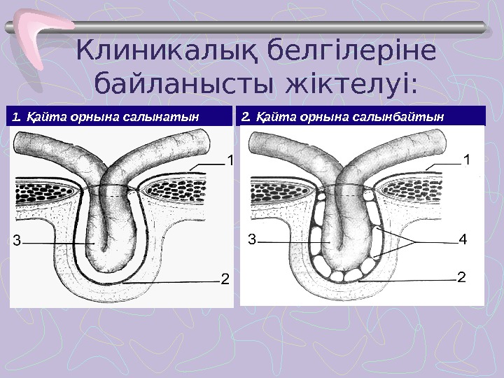 Грыжа передней брюшной стенки операция. Пластика передней брюшной стенки. Грыжа передней брюшной стенки на кт. Грыжи брюшной стенки Факультетская хирургия.