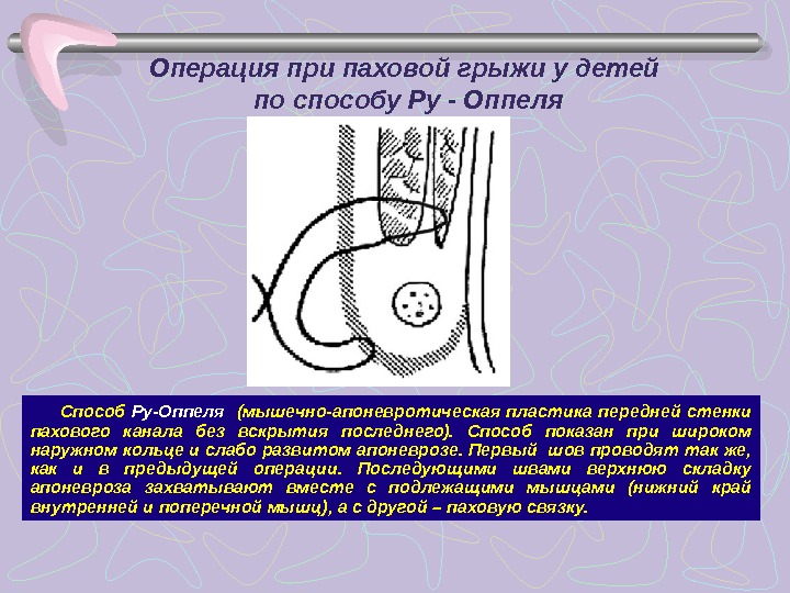 Схема пластики пахового канала