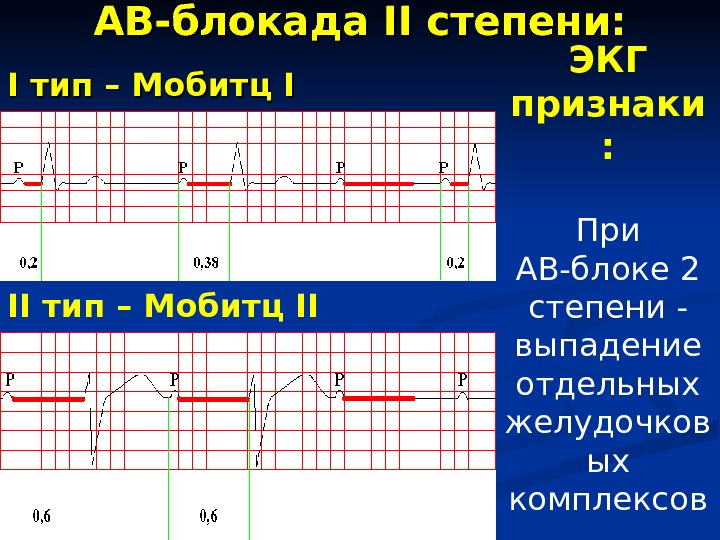 Ав блокада 2. ЭКГ признаки АВ блокады 2 степени Мобитц 1. АВ-блокады II степени: Мобитц 2 ЭКГ. АВ блокада 2 степени Мобитц 2 на ЭКГ. Блокада Мобитц 1 на ЭКГ.