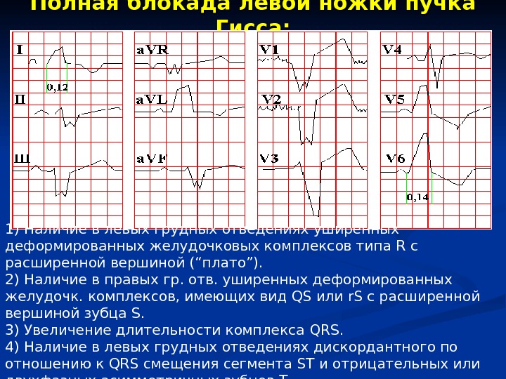 Полная блокада левой ножки пучка гиса фото на экг