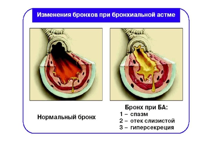 Презентация аллергические заболевания кожи