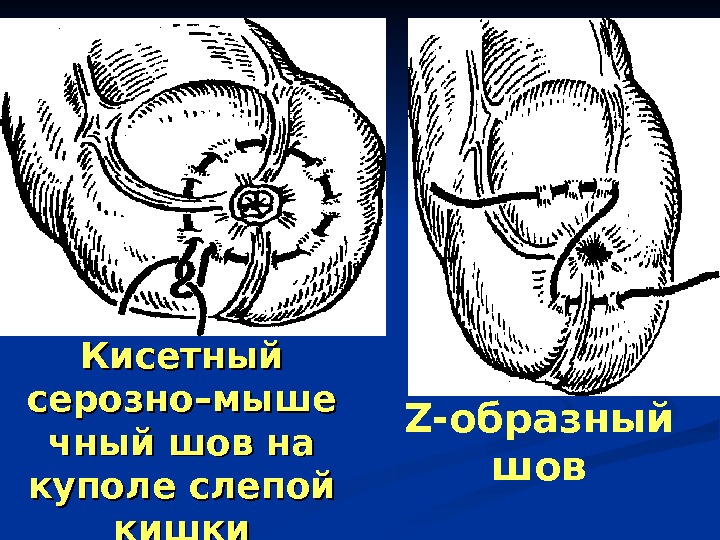 Абдоминальная пункция презентация