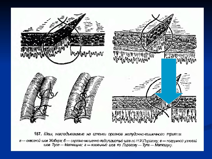 Кишечные швы. Кишечный сквозной шов Шмидена. Погружной шов техника наложения. Шов Жобера кишечный. Погружные швы в хирургии.
