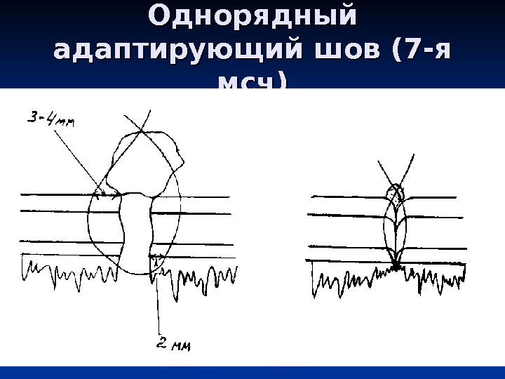 Абдоминальная пункция картинки