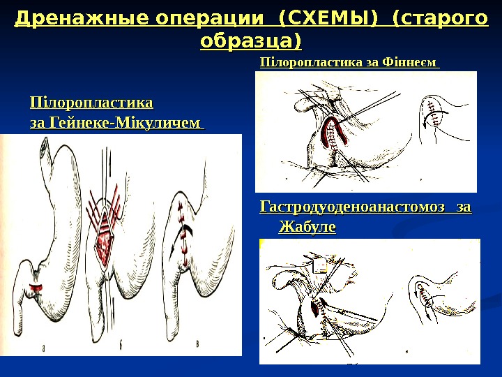 Пилоропластика по финнею схема