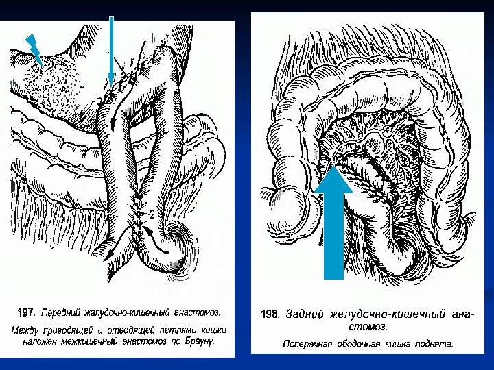 Анастомоз по брауну схема