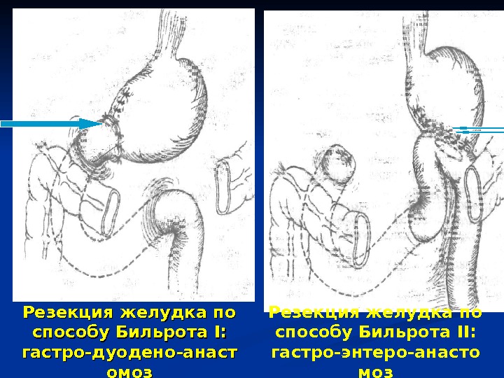 Абдоминальная пункция презентация