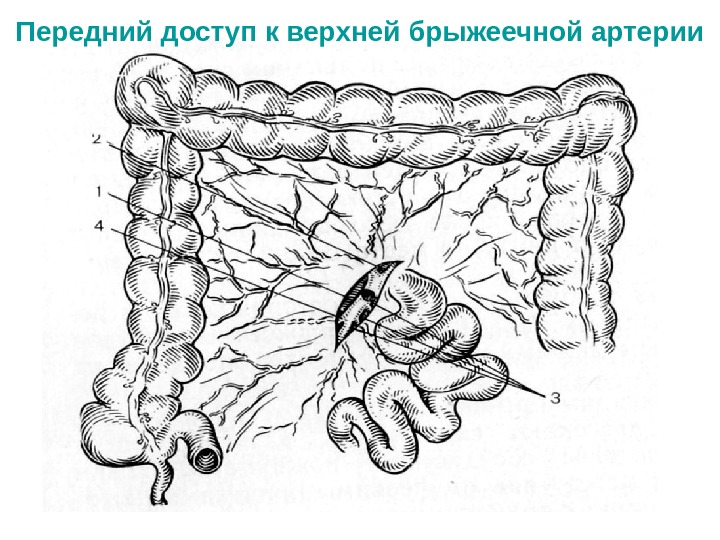 Синдром брыжеечной артерии