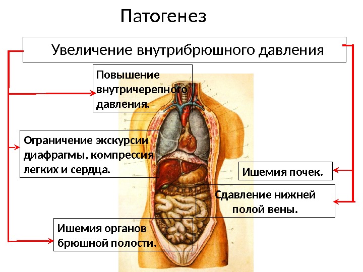 Брюшной полости причина. Повышение внутрибрюшного давления. Повышенное внутрибрюшное давление. Повышенное внутрибрюшное давление симптомы. Повышение давления в брюшной полости.