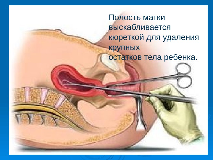 Полость матки. Выскабливание кюреткой. Хирургический аборт на 12 неделе. Выскабливание полости матки аборт.