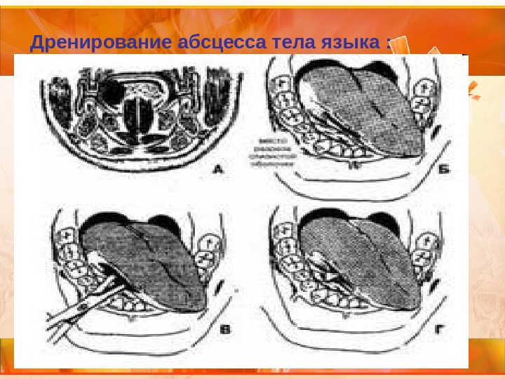 Флегмона корня и тела языка. Абсцесс и флегмона корня языка. Вскрытие абсцесса корня языка.