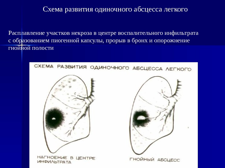 Абсцесс легкого рисунок