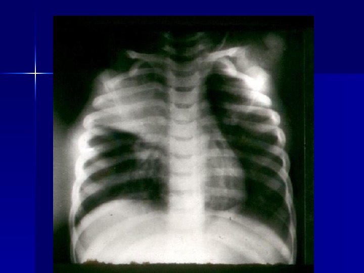 Лобить. Гангрена легкого рентген. Рентгенография при абсцессе легкого до прорыва. Абсцесс грудной клетки.