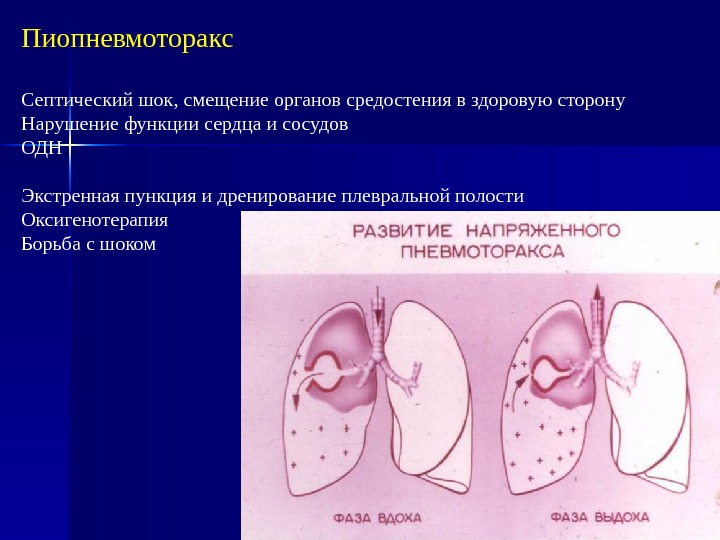 Гангрена легкого рисунок