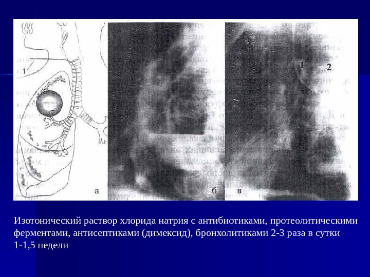 Гангрена легкого презентация