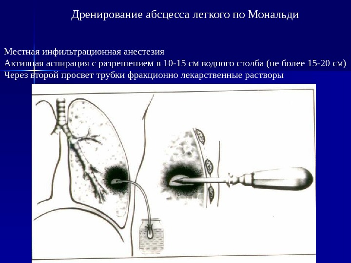 Абсцесс легкого презентация хирургия