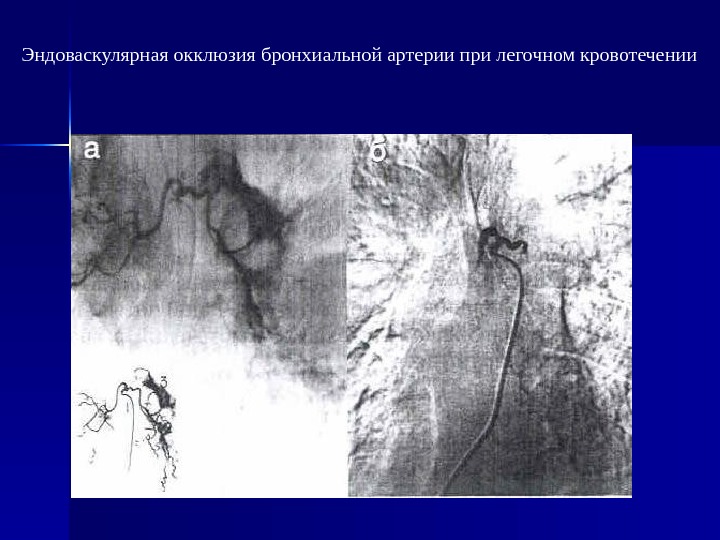 Гангрена легкого презентация