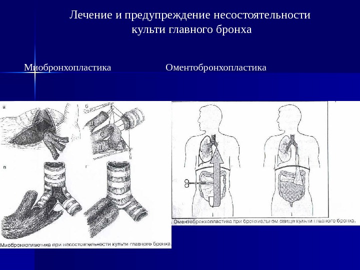 Несостоятельность культи. Культя главного бронха. Несостоятельность культи главного бронха. Несостоятельности культи бронха несостоятельность. Обработка культи бронха.