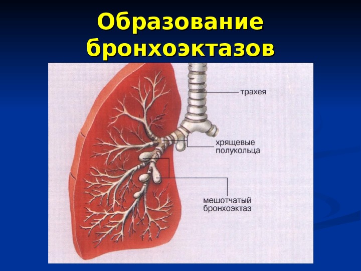 Бронхоэктазы