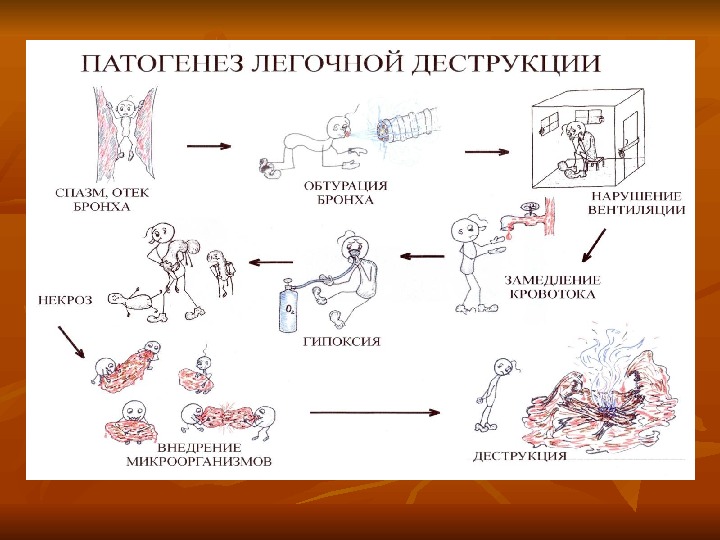 Абсцесс легкого патогенез схема