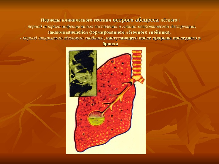 Легкого периода. Абсцесс легкого презентация. Острый абсцесс легкого. Абсцесс легкого периоды клинического течения.