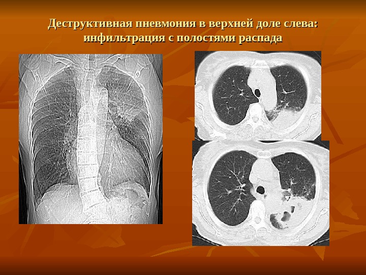 Деструктивная пневмония. Деструктивная пневмония на кт легких. Пневмония с полостью распада кт. Деструктивная пневмония на кт. Деструктивный распад легкого.