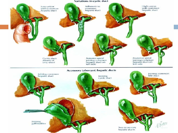 ACUTE CHOLECYSTITIS Supervisor: Dr. Abbas Mohammed By: Abdullah