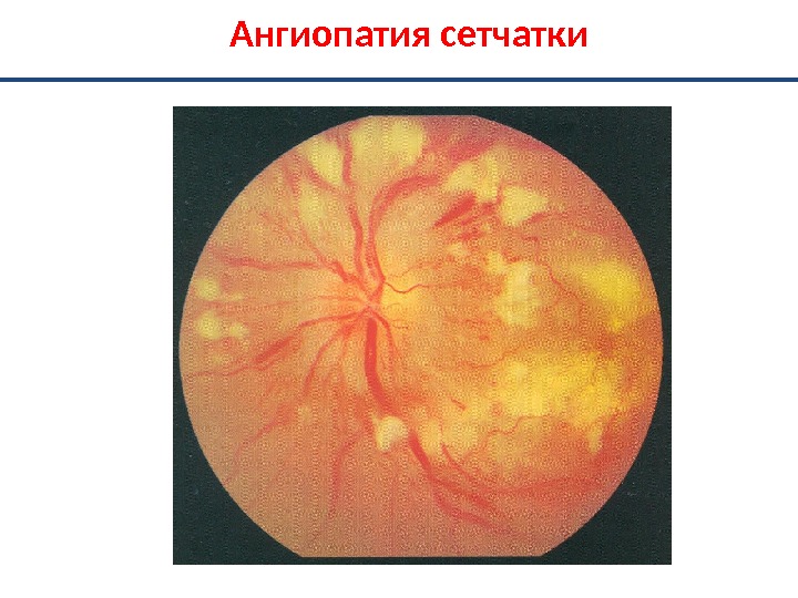 Ангиопатия сосудов сетчатки что это. Ангиопатия сосудов глаз. Диабетическая ангиопатия глаз. Гипертоническая ангиопатия сетчатки глазное дно. Гипотоническая ангиопатия сетчатки глаз.