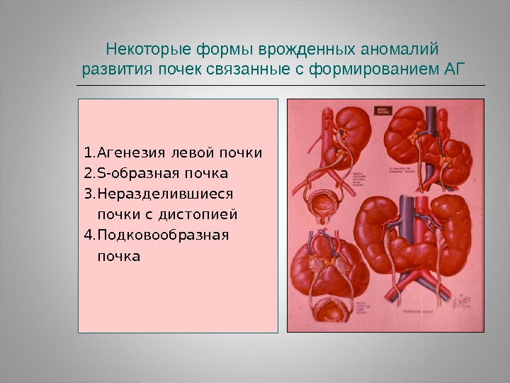 Агенезия венозного. Врожденные пороки развития мочеполовой системы. Врожденные пороки развития выделительной системы. Аномалии мочевыделительной системы у детей. Аномалии развития почек формы.