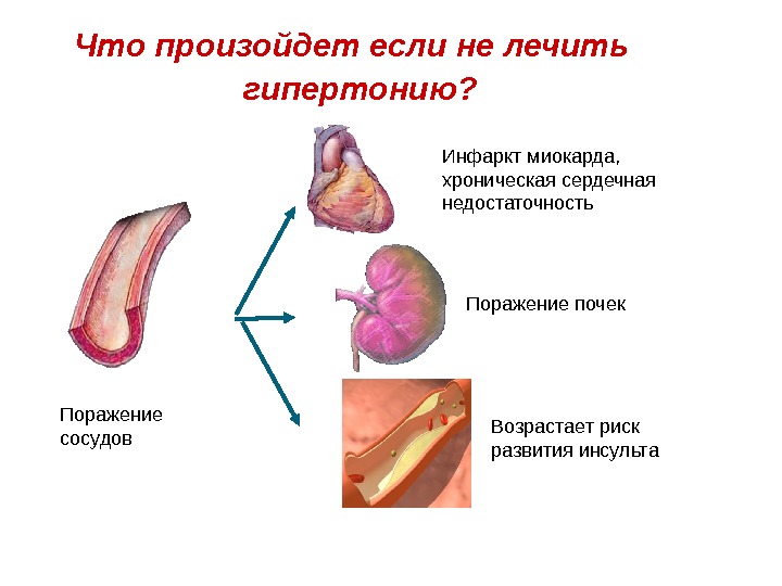 Как лечить гипертонию. Что будет если не лечить гипертонию. Хроническая сердечная недостаточность инфаркт миокарда. Поражение почек при ХСН. Что если не лечить гипертензию.