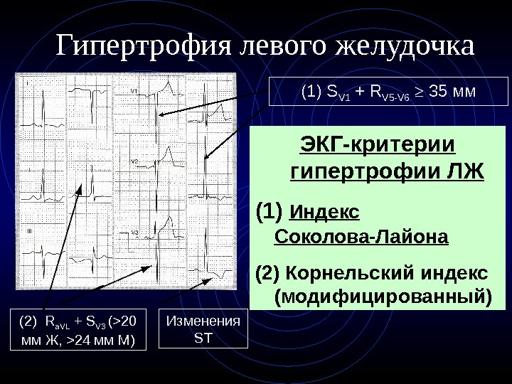 Признаки гипертрофии левого желудочка на экг