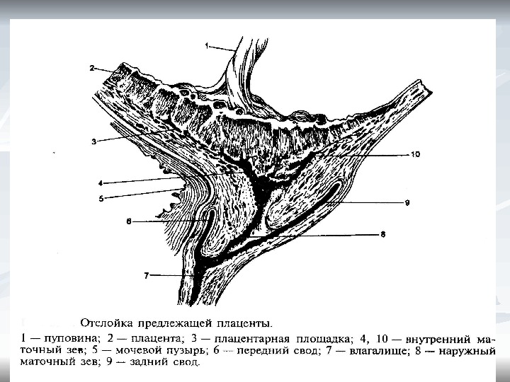 Отслойка плаценты карта вызова