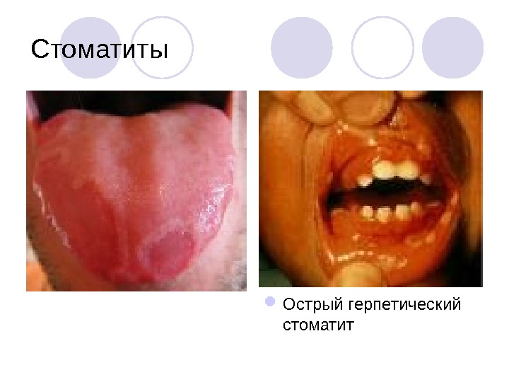 Аллергические реакции в стоматологии презентация