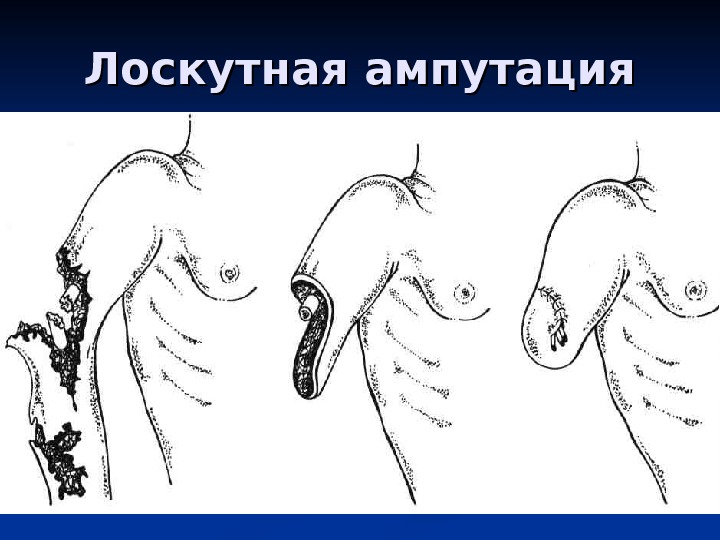 Принцип лоскута. Лоскутный способ ампутации. Этапы ампутации конечности. Однолосеутная ампутация.