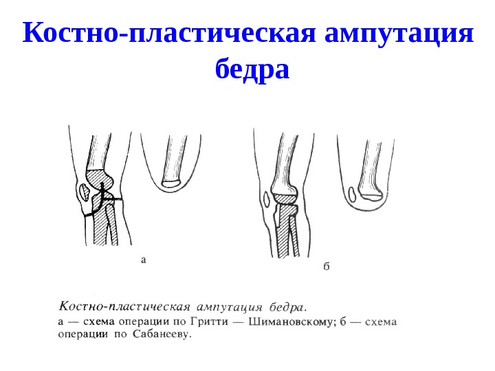 Ампутация плеча презентация