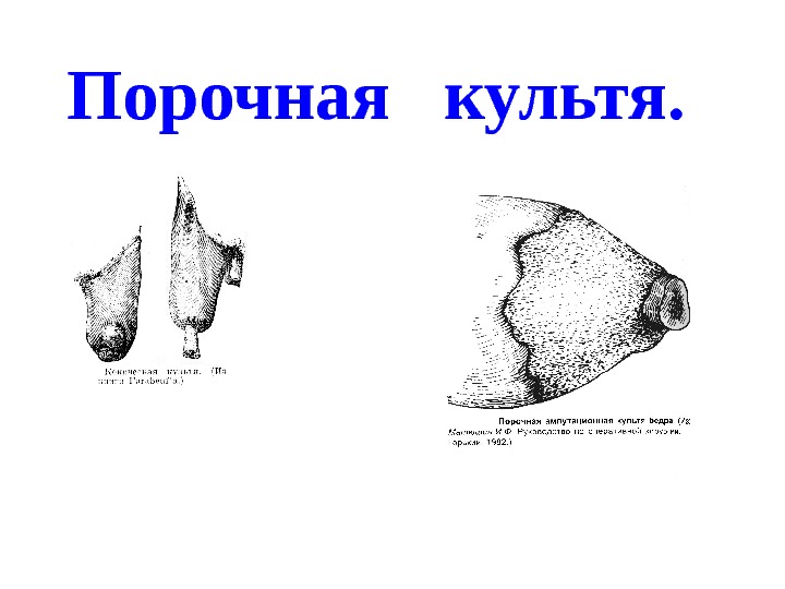 Культа ноги. Порочная ампутационная культя. Патологическая коническая культя. Коническая форма культи.