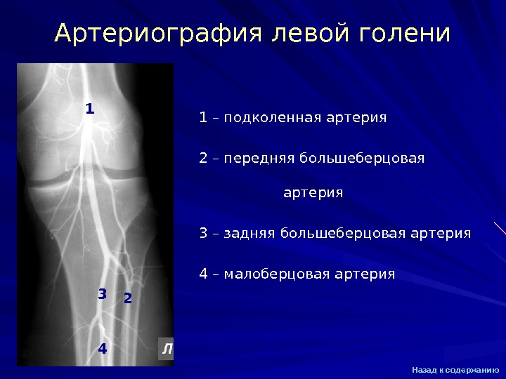 Окклюзия подколенной артерии. Подколенная артерия кт. Ангиография подколенной артерии. Бедренная артерия кт анатомия. Подколенная артерия анатомия кт.