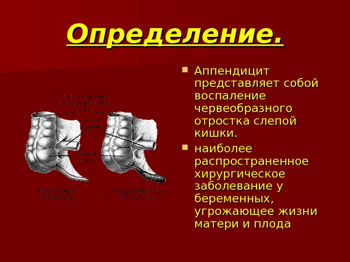 Острый аппендицит у беременных презентация