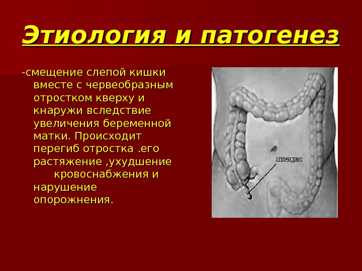 Где находится аппендицит у человека и какие признаки бывают у мужчин фото