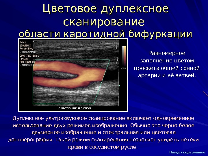 Дуплексное сканирование. Цветное дуплексное сканирование. Область каротидной бифуркации что это. Дуплексное сканирование бифуркации аорты. Просвет каротидной бифуркации.