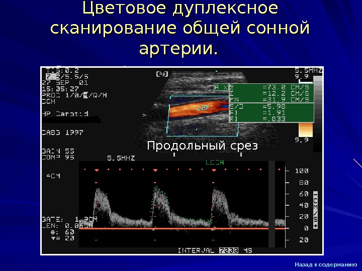 Дуплексное сканирование что это. Нормы дуплексного сканирования брахиоцефальных сосудов. Экстракраниальное дуплексное сканирование сосудов шеи. Цветовое дуплексное сканирование. Цветное дуплексное сканирование экстракраниальных артерий.