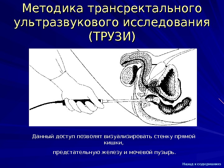 Подготовка к трузи. Трансректальное пальцевое исследование. Трансректальное пальцевое исследование простаты. Пальпация предстательной железы через прямую кишку. Трансректальное пальцевое исследование что это у мужчин.