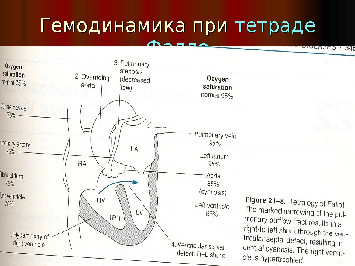 Тетрада фалло гемодинамика схема