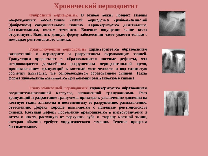 Хронический фиброзный периодонтит лечение. Описание хронического гранулематозного периодонтита. Обострение хронического периодонтита рентген. Хронический фиброзный периодонтит описание снимка.