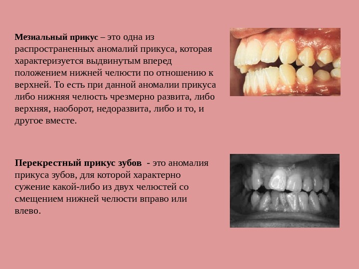 Мезиальный прикус