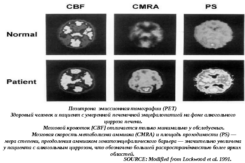 Цирроз пропедевтика. Кт признаки цирроза печени. Осложнения при томографии.